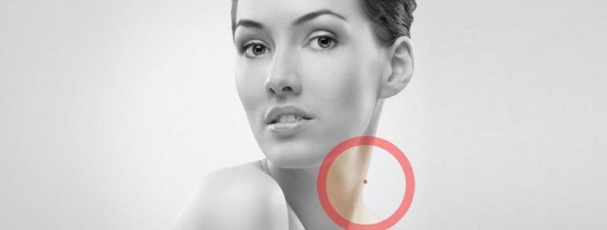 jóindulatú bőrnövedék bőrkinövés fibróma eltávolítás levétel lézerrel budapest xi xxii xxi xxiii xx ix viii i xii